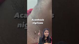 Acanthosis Nigricans | #darkskin #skintags #Shorts #youtubeshorts