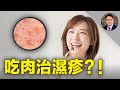 💡揭秘造成濕疹的5大元兇！採用這種饮食方式，不吃藥就可讓濕疹消失！