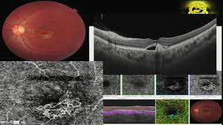 AIOC2018 - IC208 - OCT angiography : all vascular networks are not to be treated - Dr.Rohan Chawla