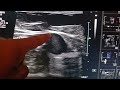 ultrasound evaluation of lower limb venous insufficiency atypical varicose vein .