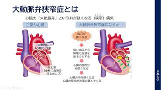 「最近の心臓手術ー狭心症、弁膜症から大動脈解離までー」　松尾　武彦