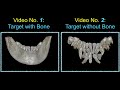 Innovative Impaction Treatment in AAO 2018 Part 6｜【Chris Chang Ortho】CC467