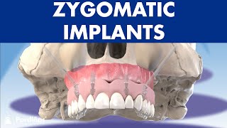 ZYGOMATIC implants - How to place dental implants without bone ©