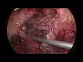 Laparoscopic Chronic Ectopic management