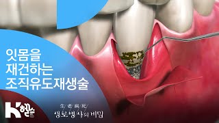 잇몸을 재건하는 조직유도재생술 - (20181114_670회 방송) 3분의 힘, 잇몸병 개선 프로젝트