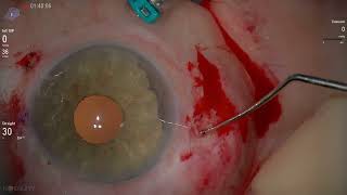 Treatment of traumatic aphakia and iridodialysis with CUSTOMFLEX® ARTIFICIALIRIS from HumanOptics