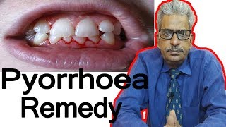 Pyorrhea - Discussion and Treatment in Homeopathy by Dr. P.S. Tiwari Pyorrhea - Discussion and Treatment in Homeopathy by Dr. P.S. Tiwari