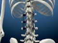 Synster Pedicle Screw.avi