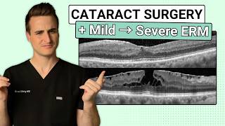 Epiretinal Membrane and Cataract Surgery - MD Explains What to Know Before Surgery