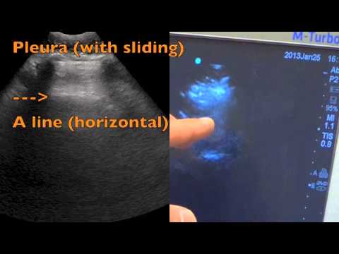 Pulmonary Edema Evaluation Using Ultrasound - YouTube