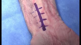 Volar Henry Approach to the Distal Radius: Resident Training (Cadaveric)