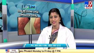 Varicose Veins || Homeopathy Treatment || Lifeline - TV9