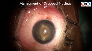 Management of Traumatic Cataract with Dehiscence in posterior capsule