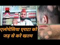 Rogan zarareeh ke fayde alopecia areata treatment Oil