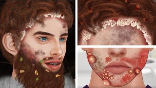 ASMR how to best treatment and remove dandruff and sebum for forest people | 최고의 케어 애니메이션 2023