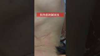 斜角筋刺鍼実技　#shorts  #鍼灸  #斜角筋