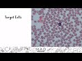 beta thalassemia heme onc usmle step 1