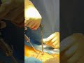 dual portal endoscopic spine surgery ultra minimally invasive