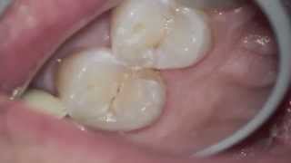 What's this chip on my tooth?