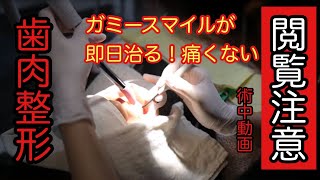 閲覧注意　歯肉整形　施術中