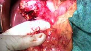 Biliary-Dr Bumgart's Video Atlas: Liver, Biliary \u0026 Pancreatic Surgery