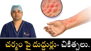 Acute Urticaria Treatment Methods | చర్మం పై దుద్దుర్లు- చికిత్సలు