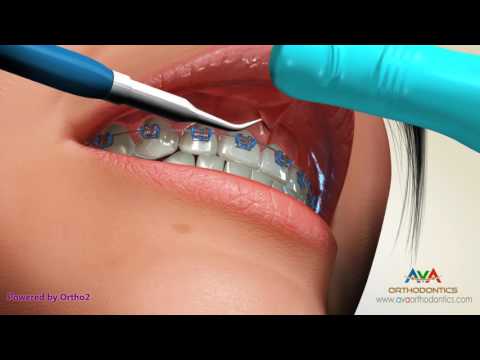 What is the upper lip bone called?