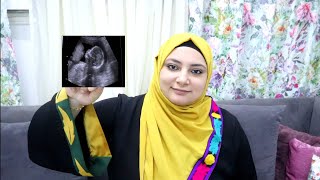 علامات معرفة جنس الجنين🤰قبل السونار #انس_اصاله