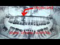 Surgical extraction of impacted upper premolar