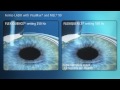 flexiquence femto lasik animation