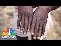 What You Need To Know About The Monkeypox Virus