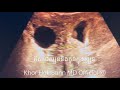 គីសដៃស្បូននិងការមានកូន l ovarian cyst and pregnancy l khor hok sunn md official