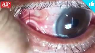 استخراج الدود من عين إنسان Extracting worms from a person's eye