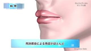 かぜ症候群／ミルメディカル　家庭の医学動画版