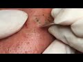 squeezing out pimples black spots on the face прыщи 2025 acne.