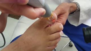 Laser Treatment of Fungal Toe Nail with a Cutera Laser