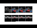 Accuracy of Retinal Imaging Using Artificial Intelligence (AI)