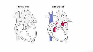 What is Hypoplastic Left Heart Syndrome?