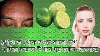 Best Home Remedy for Acne 7 Days 2019 ||  ৭ দিনে  ব্রণ ও তা থেকে হওয়া কালো দাগ  দূর করুন ।