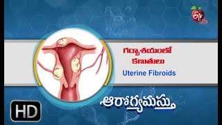 Aarogyamastu | Uterine Fibroids | 23rd November 2017 | ఆరోగ్యమస్తు