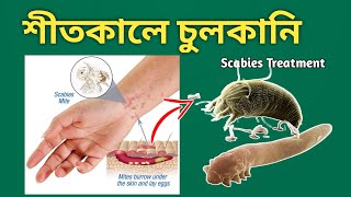 Scabies: চুলকানির চিকিৎসা