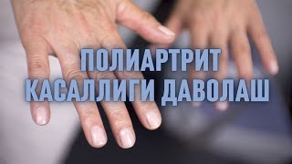 Полиартрит касаллиги даволаш | Полиартрит лечение