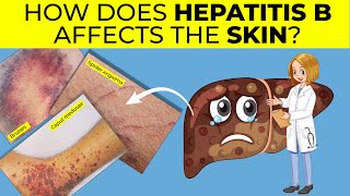 How Does Hepatitis B Affect the Skin? | Hepatitis B and Skin Rashes | Hepatitis B and Itchy Skin
