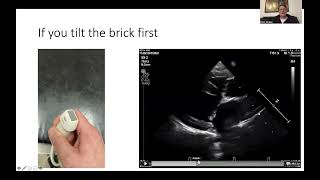 An Easy Way To Find a Proper Right Parasternal 5-Chamber View [5 SonoMinutes with SonoPath]