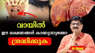 വായിൽ ഈ ലക്ഷണങ്ങൾ കാണുന്നുണ്ടോ ശ്രദ്ധിക്കുക   /Dr Shimji /#baijusvlogs /Nipah