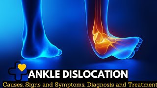 Ankle Dislocation, Causes, Signs and Symptoms, Diagnosis and Treatment.