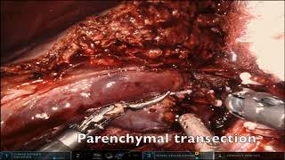 Parenchymal transection for robotic right hepatectomy | Narrated tutorial