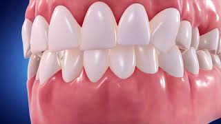 Invisalign: Straight Talk Video