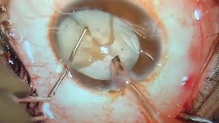 Management of ZD in Intumescent cataract with RD. Dr Naveen Gopal