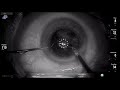 Infrared + Polarised illumination in cataract surgery Lukan Mishev